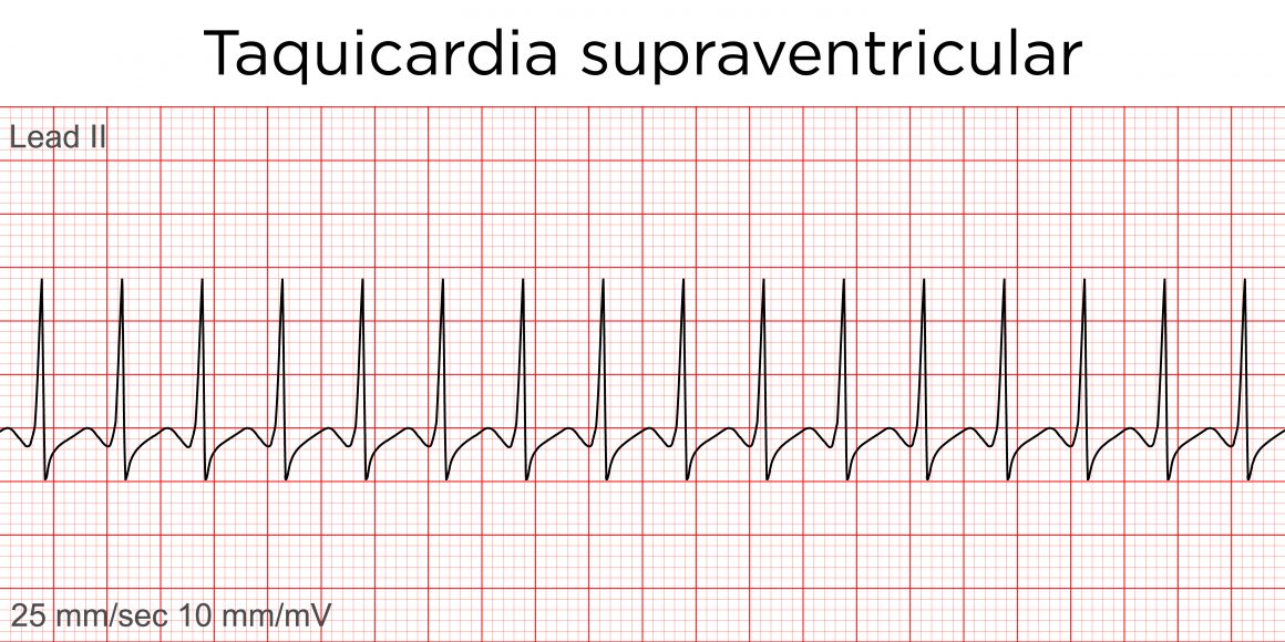 Taquicardia Supraventricular na emergência pediátrica Diagnóstico e