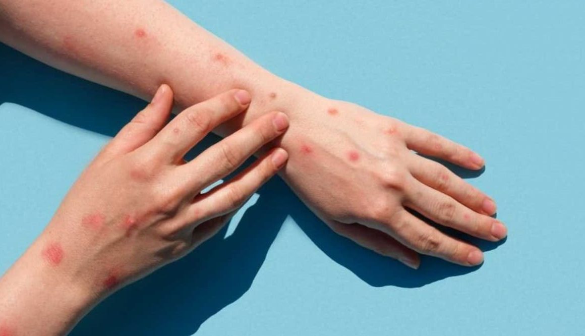 Varíola dos Macacos