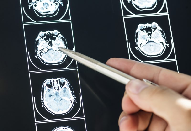 Acidente Vascular Cerebral (AVC)