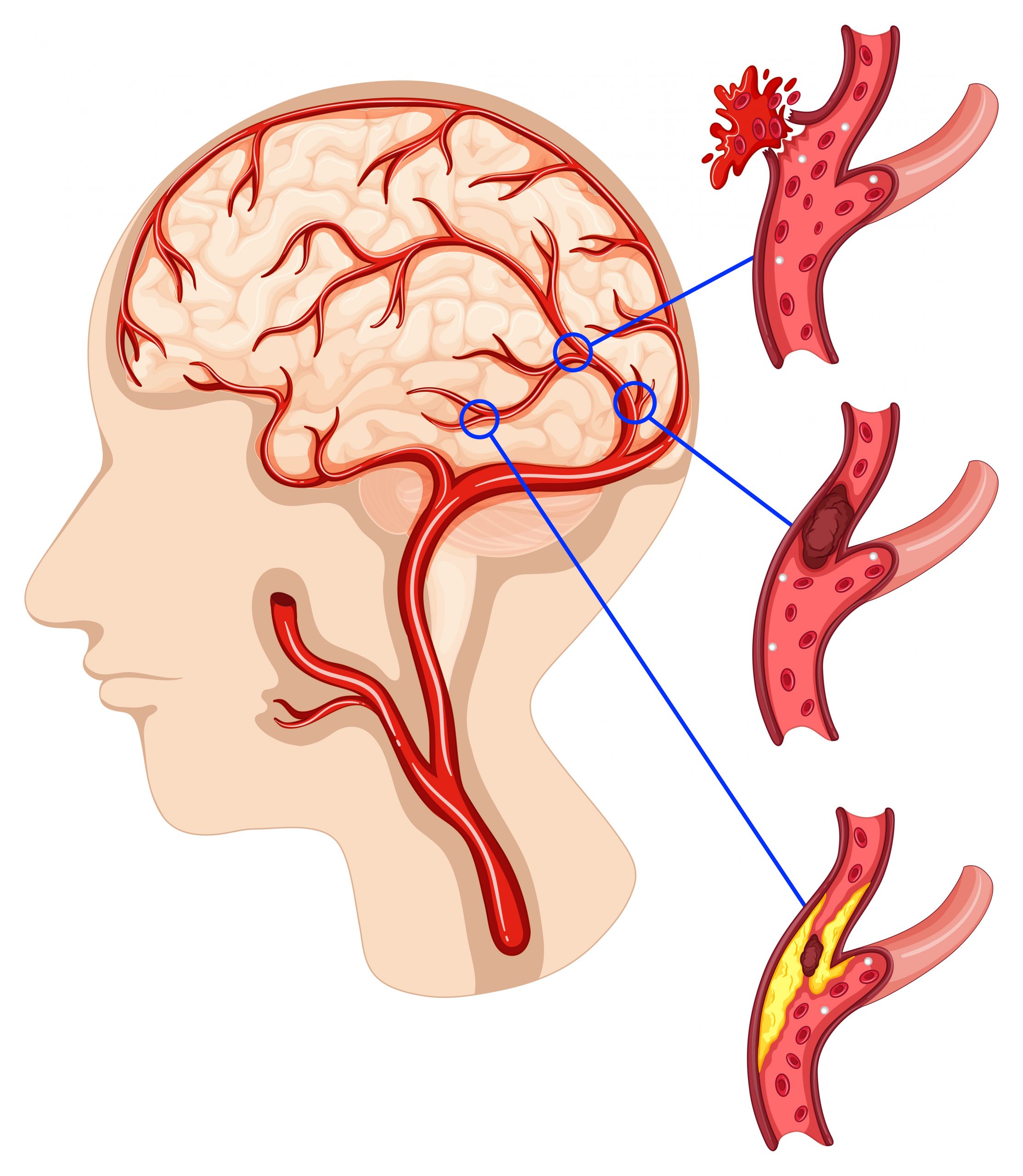 Tratamento do AVC hemorrágico - CUREM Neurologia